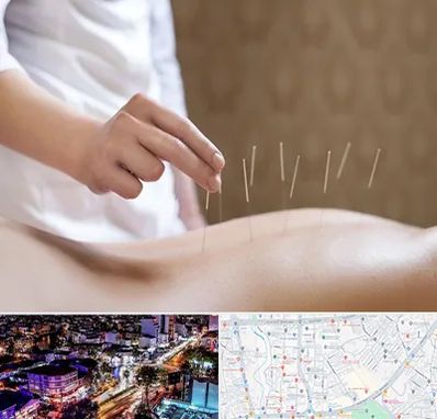 درای نیدلینگ در منظریه رشت 