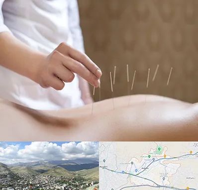 درای نیدلینگ در رودهن