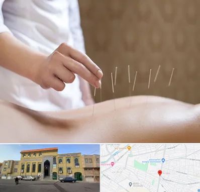 درای نیدلینگ در زنبیل آباد قم