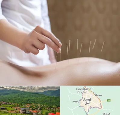 درای نیدلینگ در آمل