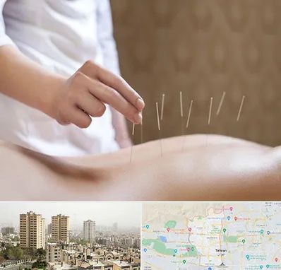 درای نیدلینگ در منطقه 5 تهران 