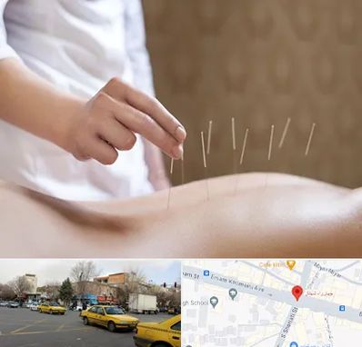 درای نیدلینگ در شهناز تبریز