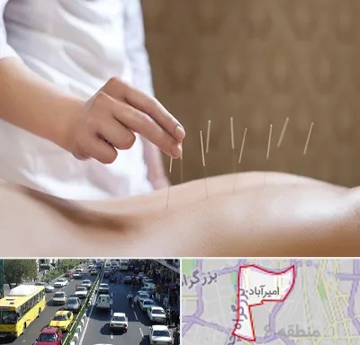 درای نیدلینگ در امیرآباد