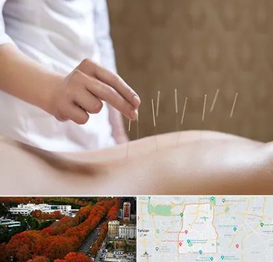 درای نیدلینگ در منطقه 6 تهران 