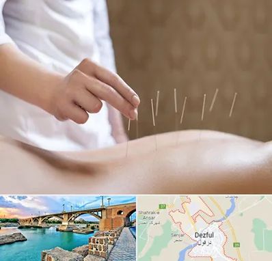 درای نیدلینگ در دزفول