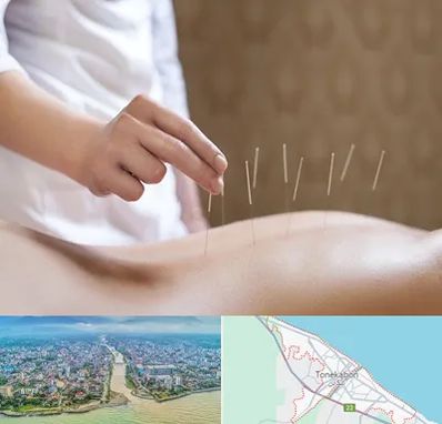 درای نیدلینگ در تنکابن