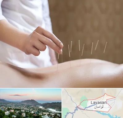 درای نیدلینگ در لواسان