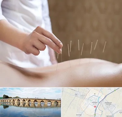 درای نیدلینگ در فلاورجان