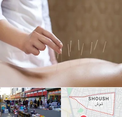 درای نیدلینگ در شوش