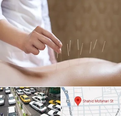 درای نیدلینگ در مطهری تهران