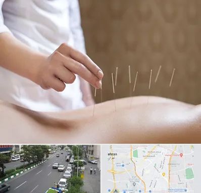 درای نیدلینگ در ستارخان 