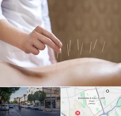 درای نیدلینگ در شهرک ولیعصر