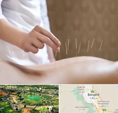 درای نیدلینگ در بروجرد