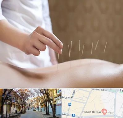 درای نیدلینگ در تربیت تبریز