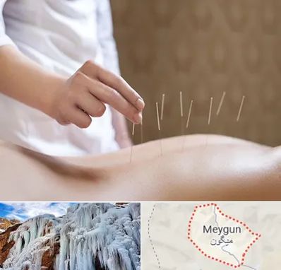 درای نیدلینگ در میگون