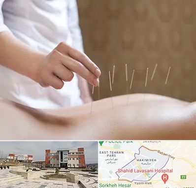 درای نیدلینگ در حکیمیه