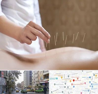 درای نیدلینگ در فاطمی 