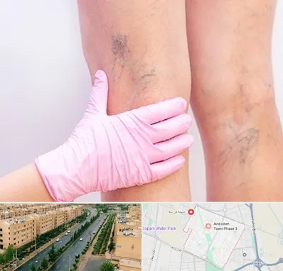 دکتر فوق تخصص واریس در فاز سه اندیشه