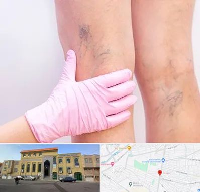 دکتر فوق تخصص واریس در زنبیل آباد قم