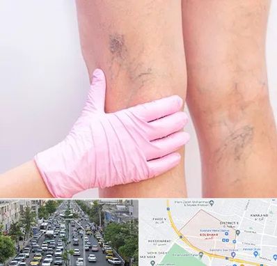 دکتر فوق تخصص واریس در گلشهر کرج 