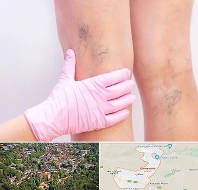 دکتر فوق تخصص واریس در دماوند