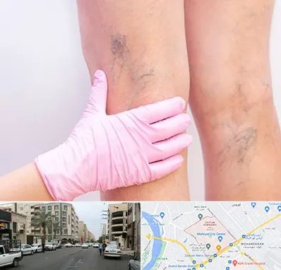 دکتر فوق تخصص واریس در زیتون کارمندی اهواز 