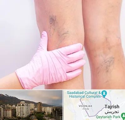 دکتر فوق تخصص واریس در زعفرانیه 