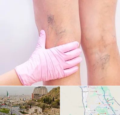 دکتر فوق تخصص واریس در فرهنگ شهر شیراز 