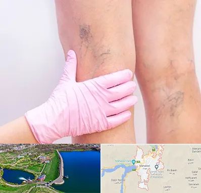 دکتر فوق تخصص واریس در مهاباد