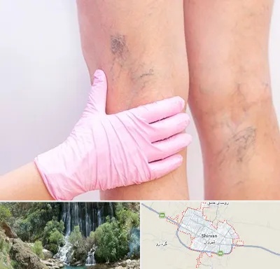 دکتر فوق تخصص واریس در شیروان