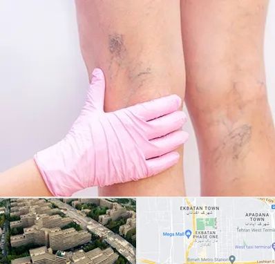 دکتر فوق تخصص واریس در اکباتان 