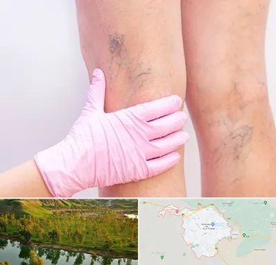 دکتر فوق تخصص واریس در بهبهان