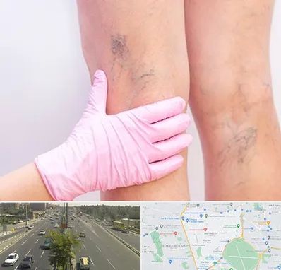 دکتر فوق تخصص واریس در منطقه 17 تهران 