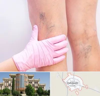 دکتر فوق تخصص واریس در دهدشت