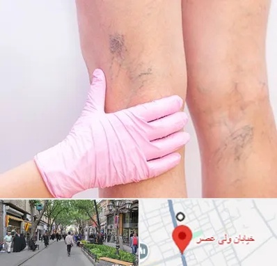 دکتر فوق تخصص واریس در ولیعصر شهریار
