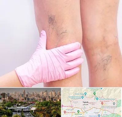 دکتر فوق تخصص واریس در منطقه 1 تهران 