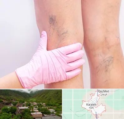 دکتر فوق تخصص واریس در کلاله
