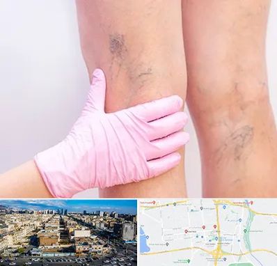 دکتر فوق تخصص واریس در شهرک راه آهن 