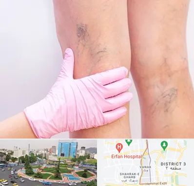 دکتر فوق تخصص واریس در ونک 