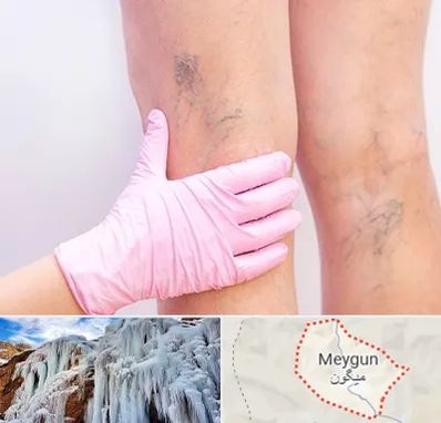 دکتر فوق تخصص واریس در میگون