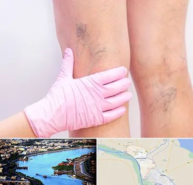 دکتر فوق تخصص واریس در خرمشهر