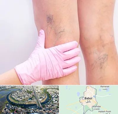 دکتر فوق تخصص واریس در بابل