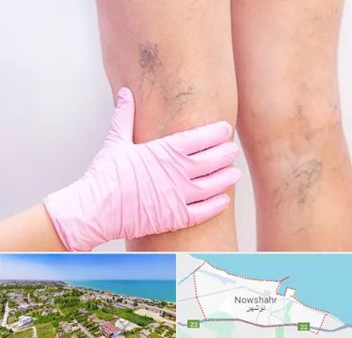 دکتر فوق تخصص واریس در نوشهر