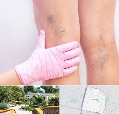 دکتر فوق تخصص واریس در باغمیشه تبریز