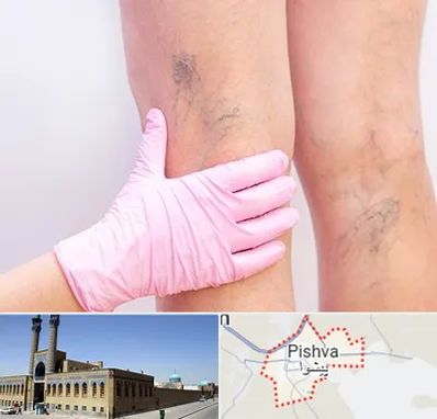 دکتر فوق تخصص واریس در پیشوا