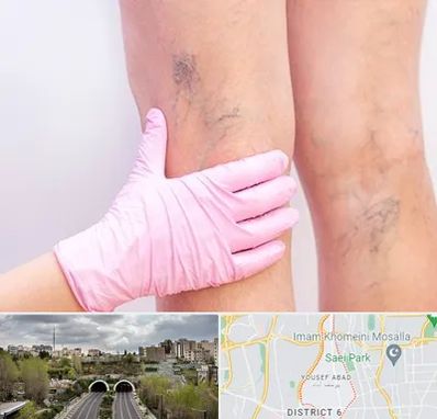 دکتر فوق تخصص واریس در یوسف آباد 