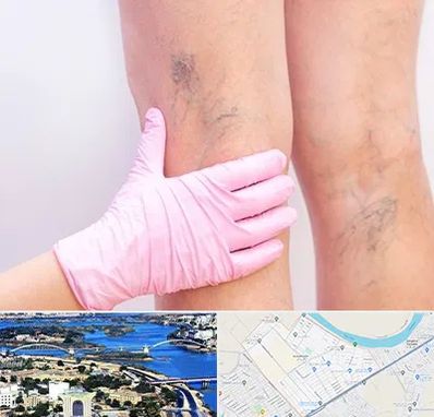 دکتر فوق تخصص واریس در کوروش اهواز 