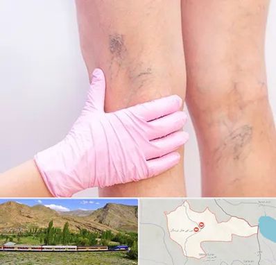 دکتر فوق تخصص واریس در خاش