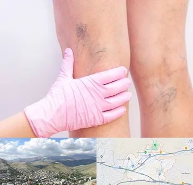 دکتر فوق تخصص واریس در رودهن