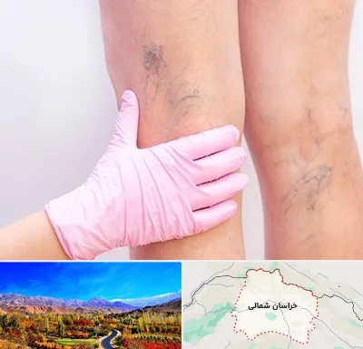 دکتر فوق تخصص واریس در خراسان شمالی